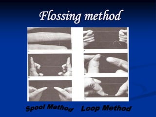 Flossing method
 