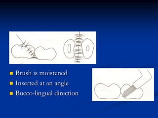  Brush is moistened
 Inserted at an angle
 Bucco-lingual direction
 