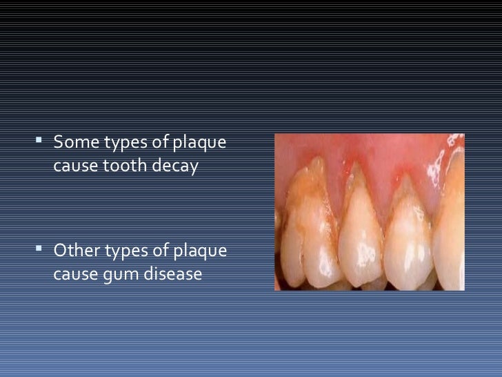 Plaque dental
