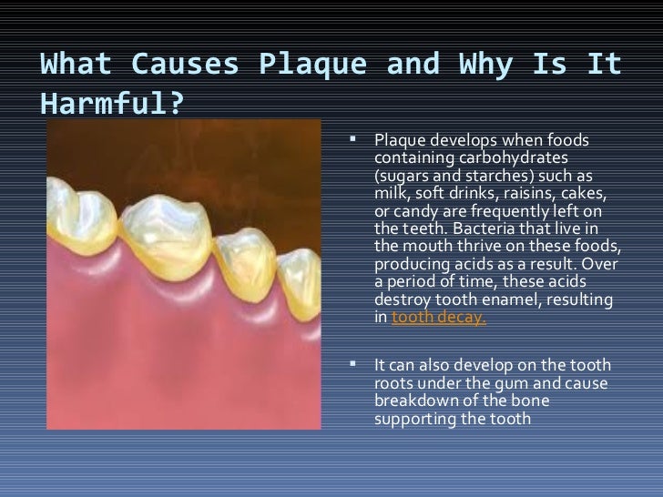 Plaque dental