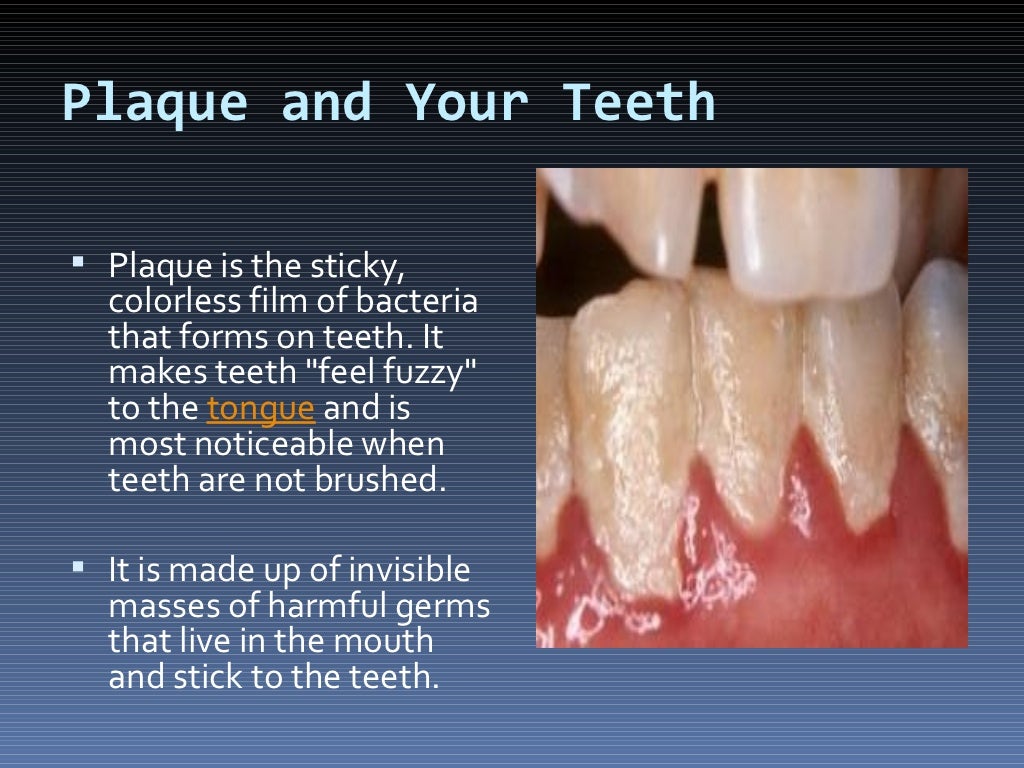 Plaque dental