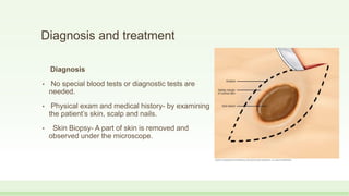 Diagnosis and treatment
Diagnosis
• No special blood tests or diagnostic tests are
needed.
• Physical exam and medical history- by examining
the patient’s skin, scalp and nails.
• Skin Biopsy- A part of skin is removed and
observed under the microscope.
 