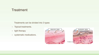 Treatment
Treatments can be divided into 3 types
• Topical treatments.
• light therapy
• systematic medications.
 