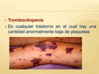  Trombocitopenia
 Es cualquier trastorno en el cual hay una
cantidad anormalmente baja de plaquetas
 