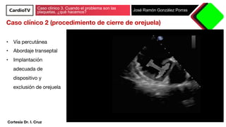 Caso clínico 3. Cuando el problema son las
plaquetas, ¿qué hacemos? José Ramón González Porras
Caso clínico 2 (procedimien...