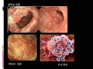 궤양성  염증 악성 종양 결핵성 염증 