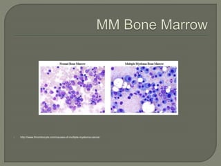  http://www.thrombocyte.com/causes-of-multiple-myeloma-cancer
 
