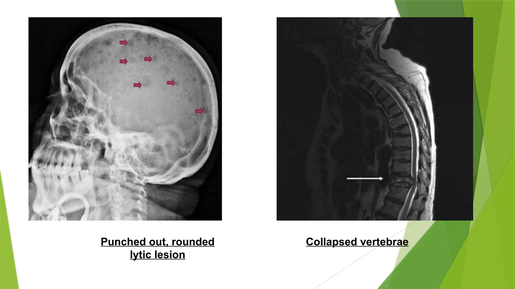 Punched out, rounded
lytic lesion
Collapsed vertebrae
 