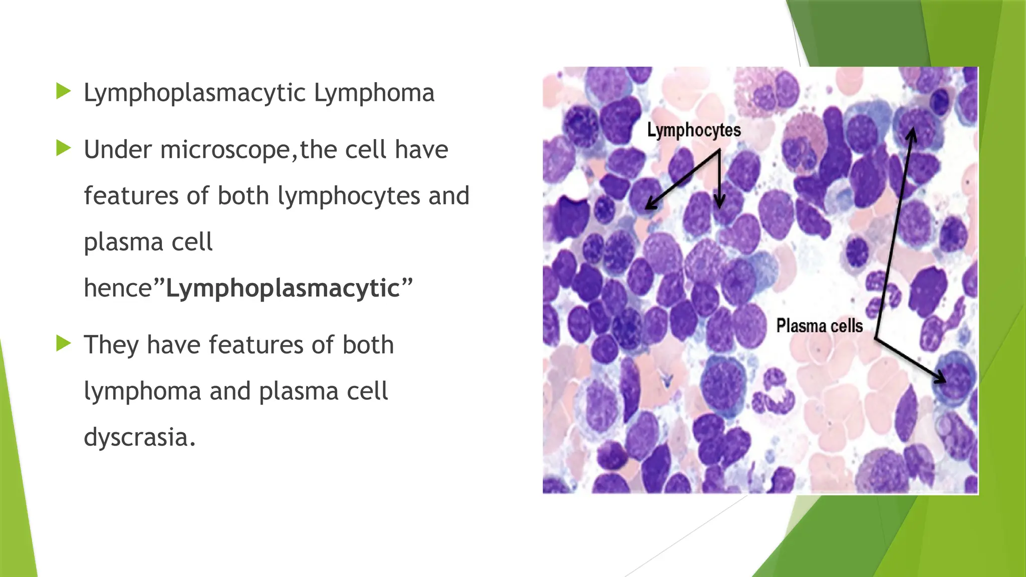  Lymphoplasmacytic Lymphoma
 Under microscope,the cell have
features of both lymphocytes and
plasma cell
hence”Lymphoplasmacytic”
 They have features of both
lymphoma and plasma cell
dyscrasia.
 