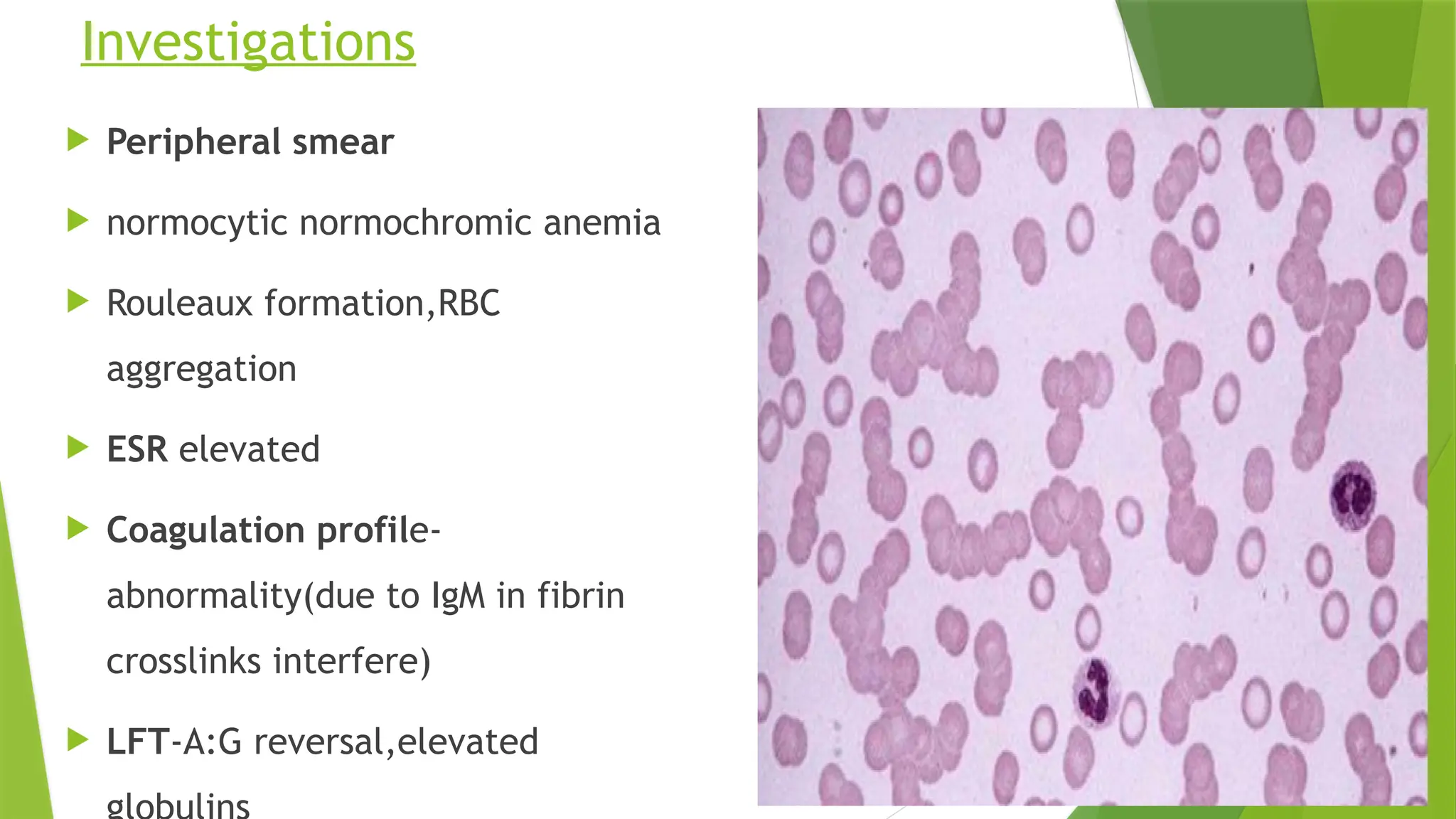 Investigations
 Peripheral smear
 normocytic normochromic anemia
 Rouleaux formation,RBC
aggregation
 ESR elevated
 Coagulation profile-
abnormality(due to IgM in fibrin
crosslinks interfere)
 LFT-A:G reversal,elevated
 