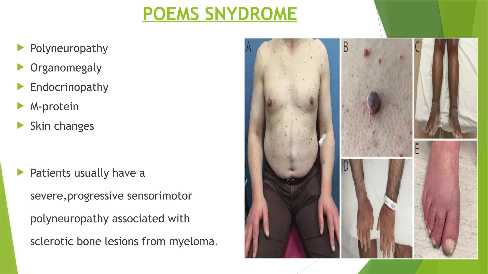 POEMS SNYDROME
 Polyneuropathy
 Organomegaly
 Endocrinopathy
 M-protein
 Skin changes
 Patients usually have a
severe,progressive sensorimotor
polyneuropathy associated with
sclerotic bone lesions from myeloma.
 