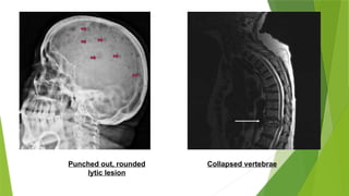 Punched out, rounded
lytic lesion
Collapsed vertebrae
 