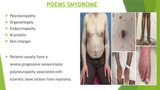 POEMS SNYDROME
 Polyneuropathy
 Organomegaly
 Endocrinopathy
 M-protein
 Skin changes
 Patients usually have a
severe,progressive sensorimotor
polyneuropathy associated with
sclerotic bone lesions from myeloma.
 