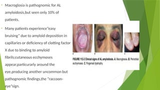 • Macroglosia is pathognomic for AL
amyloidosis,but seen only 10% of
patients.
• Many patients experience”easy
bruising” due to amyloid deposition in
capillaries or deficiency of clotting factor
X due to binding to amyloid
fibrils;cutaneous ecchymoses
appear,particurarly around the
eye,producing another uncommon but
pathognomic findings,the “raccoon-
eye”sign.
 