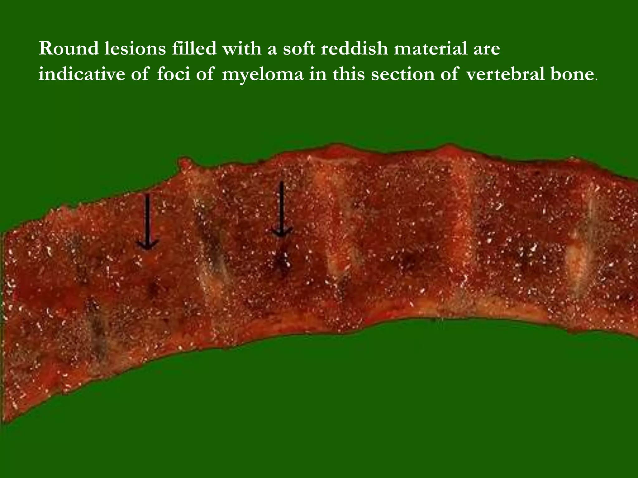 Round lesions filled with a soft reddish material are
indicative of foci of myeloma in this section of vertebral bone.
 