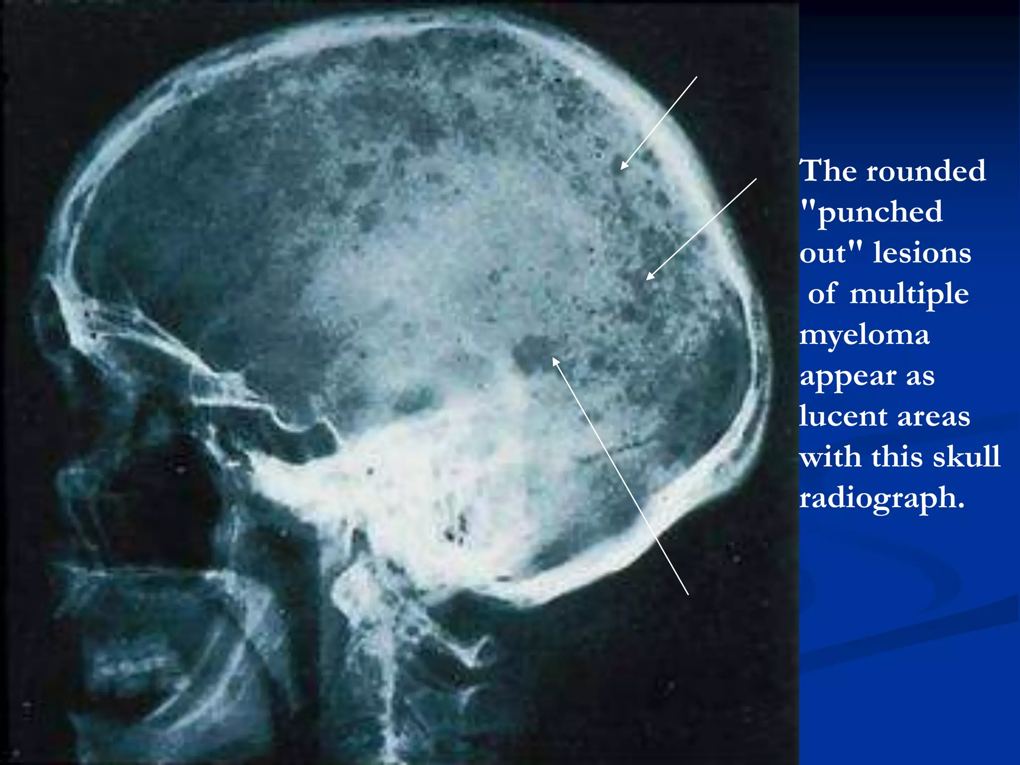 The rounded
"punched
out" lesions
of multiple
myeloma
appear as
lucent areas
with this skull
radiograph.
 