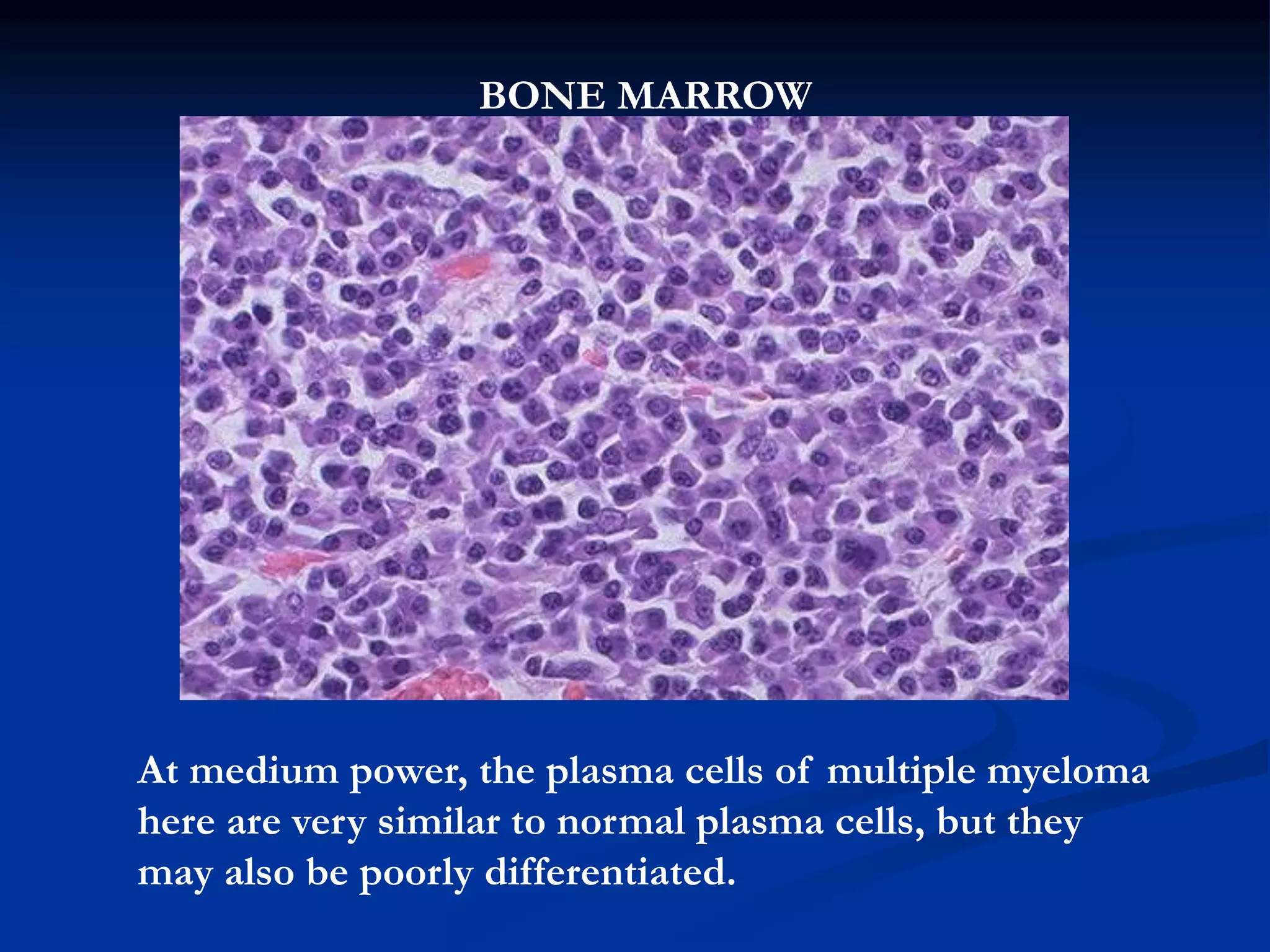 BONE MARROW
At medium power, the plasma cells of multiple myeloma
here are very similar to normal plasma cells, but they
may also be poorly differentiated.
 