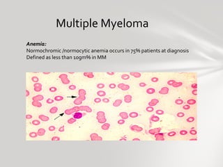 Multiple Myeloma Anemia:  Normochromic /normocytic anemia occurs in 75% patients at diagnosis Defined as less than 10gm% i...