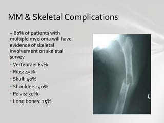 MM & Skeletal Complications <ul><li>~ 80% of patients with multiple myeloma will have evidence of skeletal involvement on ...