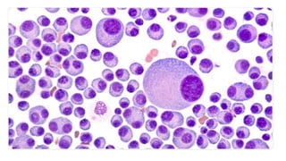 Plasma Cell Neoplasms (2021) | PPT