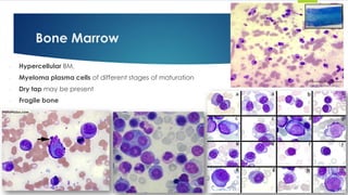 - Hypercellular BM.
- Myeloma plasma cells of different stages of maturation
- Dry tap may be present
- Fragile bone
Bone Marrow
 