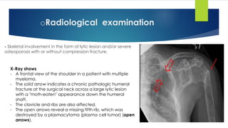 - Skeletal involvement in the form of lytic lesion and/or severe
osteoporosis with or without compression fracture.
X-Ray shows
- A frontal view of the shoulder in a patient with multiple
myeloma.
- The solid arrow indicates a chronic pathologic humeral
fracture at the surgical neck across a large lytic lesion
with a "moth-eaten" appearance down the humeral
shaft.
- The clavicle and ribs are also affected.
- The open arrows reveal a missing fifth rib, which was
destroyed by a plasmacytoma (plasma cell tumor) (open
arrows).
oRadiological examination
 
