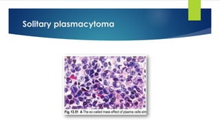 Solitary plasmacytoma
 