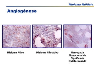 Angiogênese Mieloma Não Ativo Gamopatia Monoclonal de Significado Indeterminado Mieloma Ativo 