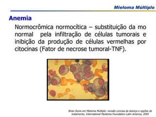 Anemia Normocrômica normocítica – substituição da mo normal  pela infiltração de células tumorais e inibição da produção de células vermelhas por citocinas (Fator de necrose tumoral-TNF). Brian Durie em Mieloma Múltiplo: revisão concisa da doença e opções de tratamento, International Myeloma Foundation Latin America, 2005 