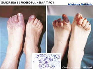 DOENÇA ÓSSE GANGRENA E CRIOGLOBULINEMIA TIPO  I Cirasino, L. ; NEJM; 1582, 1999 
