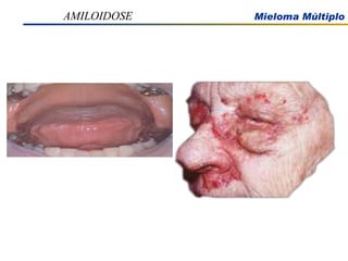 AMILOIDOSE 