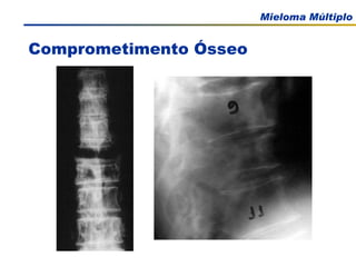 Comprometimento Ósseo 