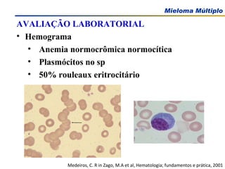 AVALIAÇÃO LABORATORIAL Hemograma Anemia normocrômica normocítica Plasmócitos no sp 50% rouleaux eritrocitário Medeiros, C. R in Zago, M.A et al, Hematologia; fundamentos e prática, 2001 