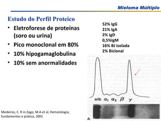 Estudo do Perfil Proteico Eletroforese de proteínas (soro ou urina) Pico monoclonal em 80% 10% hipogamaglobulina 10% sem anormalidades Medeiros, C. R in Zago, M.A et al, Hematologia; fundamentos e prática, 2001 52% IgG 21% IgA 2% IgD 0,5%IgM 16% BJ isolada 2% Biclonal 