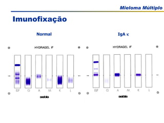 Imunofixação IgA   Normal 