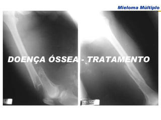 DOENÇA ÓSSEA - TRATAMENTO 