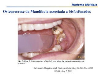 Osteonecrose da Mandíbula associada a bisfosfonados Salvatore L Ruggiero et al.  Oral Maxillofac Surg 62:527-534, 2004 NEJM , July 7, 2005 