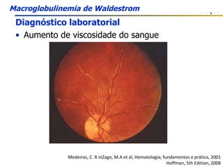 Diagnóstico laboratorial Aumento de viscosidade do sangue Medeiros, C. R inZago, M.A et al, Hematologia; fundamentos e prática, 2001 Hoffman, 5th Edition, 2008 Macroglobulinemia de Waldestrom 