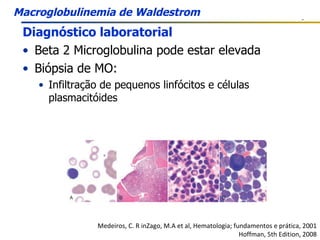 Diagnóstico laboratorial Beta 2 Microglobulina pode estar elevada Biópsia de MO: Infiltração de pequenos linfócitos e células plasmacitóides Medeiros, C. R inZago, M.A et al, Hematologia; fundamentos e prática, 2001 Hoffman, 5th Edition, 2008 Macroglobulinemia de Waldestrom 