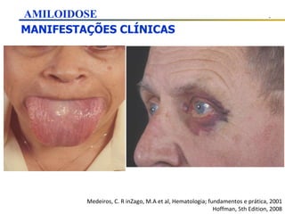 MANIFESTAÇÕES CLÍNICAS Medeiros, C. R inZago, M.A et al, Hematologia; fundamentos e prática, 2001 Hoffman, 5th Edition, 2008 AMILOIDOSE 
