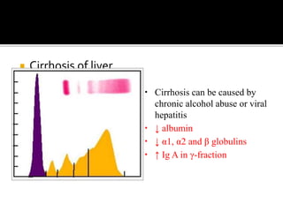  Cirrhosis of liver
• Cirrhosis can be caused by
chronic alcohol abuse or viral
hepatitis
• ↓ albumin
• ↓ α1, α2 and β globulins
• ↑ Ig A in γ-fraction
 