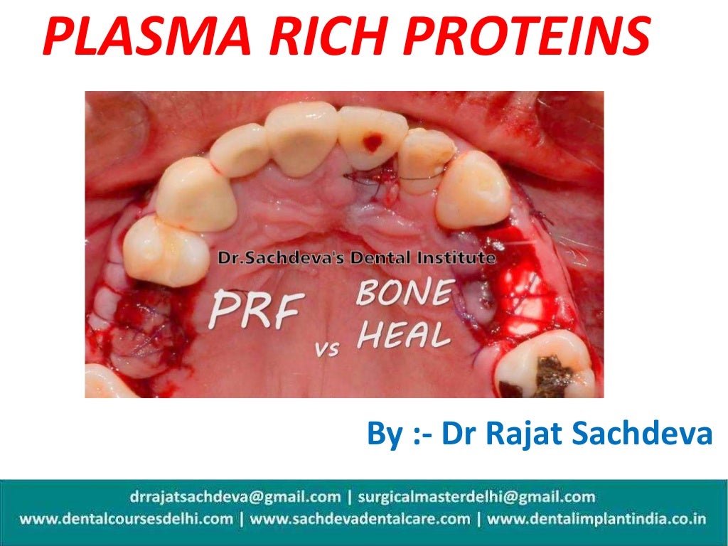 Plasma rich proteins ,PRP ,Platelets rich plasma , Dental Implants Wi…
