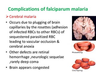 Complications of falciparum malaria
Cerebral malaria
• Occurs due to plugging of brain
capillaries by the rosettes (adhesion
of infected RBCs to other RBCs) of
sequestered parasitized RBC
leading to vascular occlusion &
cerebral anoxia
• Other defects are retinal
hemorrhage ,neurologic sequelae
,rarely deep coma
• Brain appears congested
 