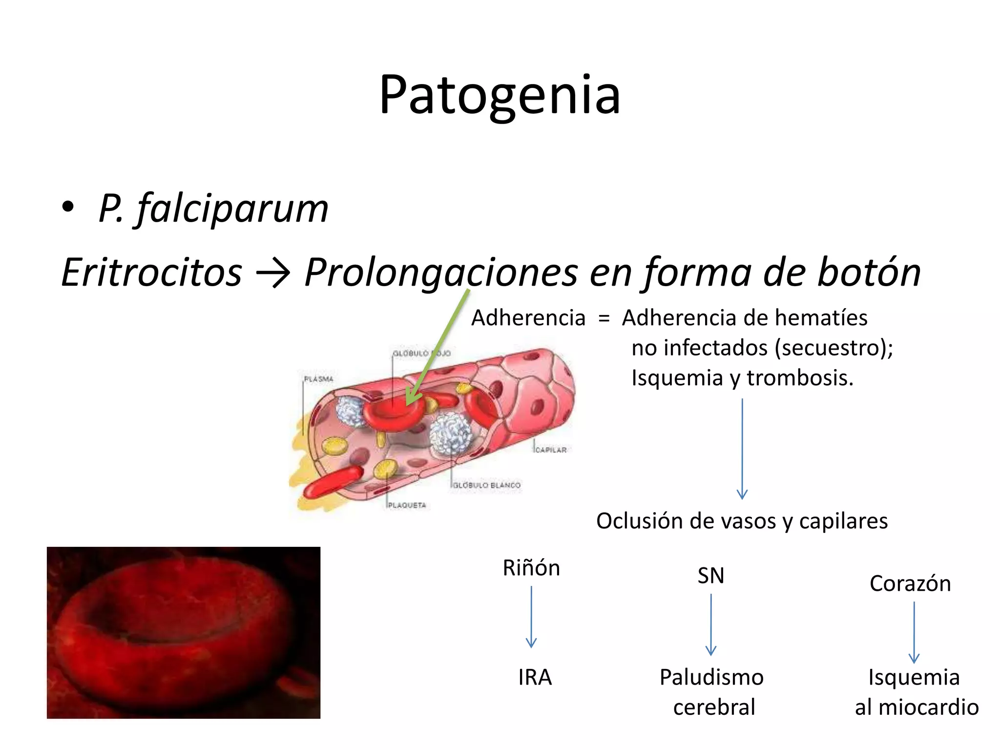 PatogeniaP. falciparumEritrocitos -> Prolongaciones en forma de botónAdherencia  =  Adherencia de hematíes                             no infectados (secuestro);                            Isquemia y trombosis.Oclusión de vasos y capilaresRiñónSNCorazónIRAPaludismo cerebralIsquemia al miocardio