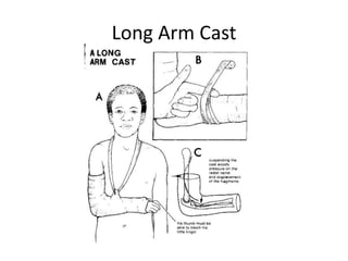 Long Arm Cast