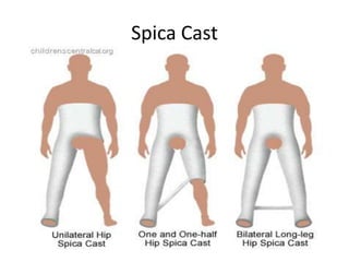 Spica Cast