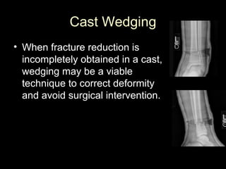 Plaster of Paris | PPT