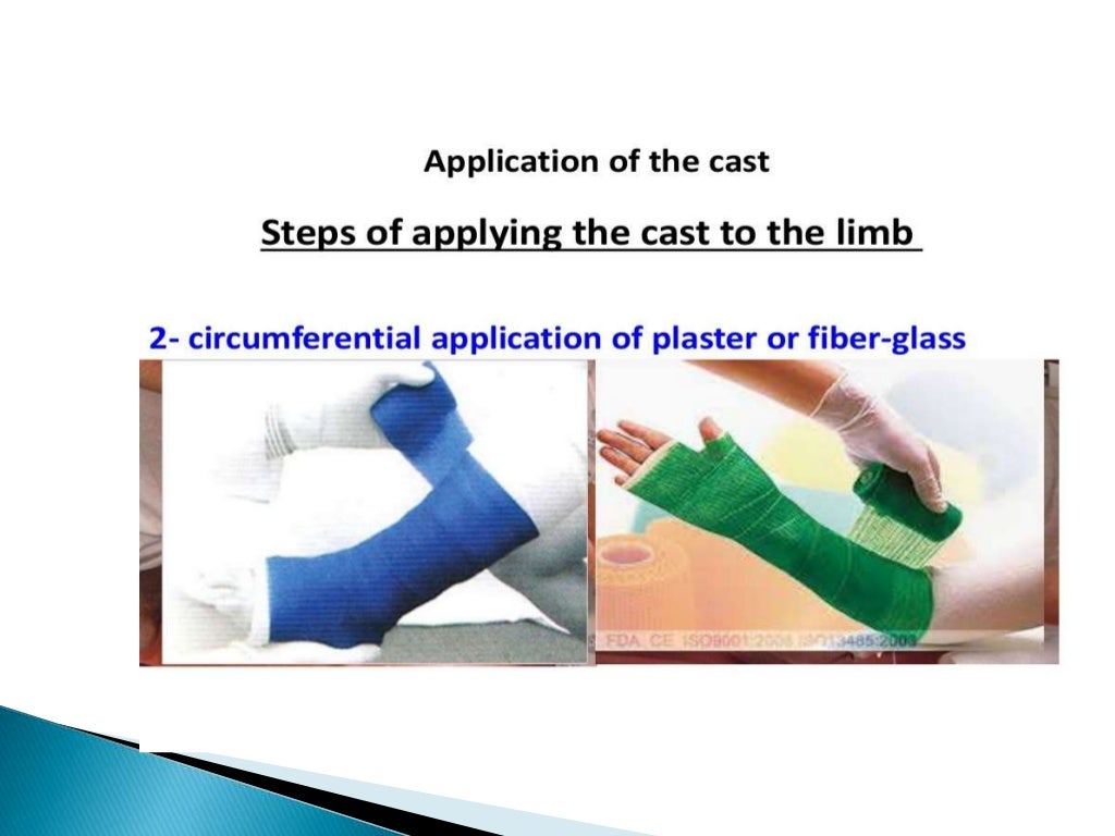 Plaster of paris ortho presentation