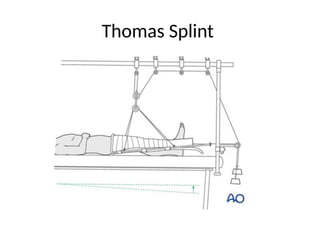 Modified Thomas Splint Plaster Orthopedic for medical undergraduate | PPTX