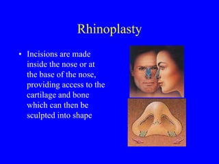 Gullwing Incision Rhinoplasty Plastic-and-Reconstructive-Surgery.NWPC_.ppt